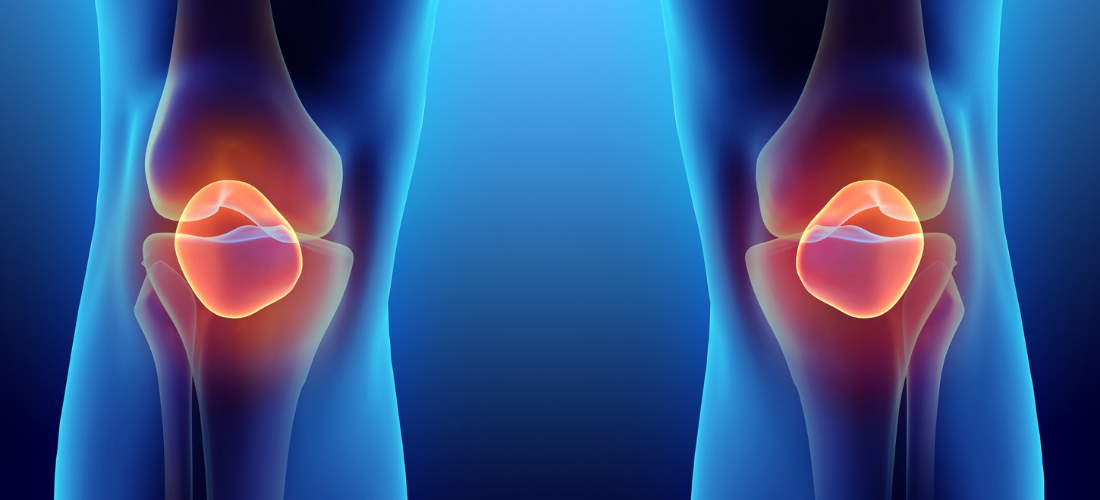3D illustration of Patella, medical concept, illustration of knee rheumatism | Doylestown Health